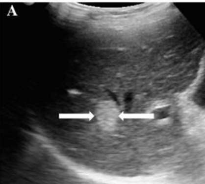 &amp;lt;2cm small hcc sono features
