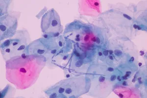 자궁암-초기증상