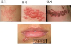 대상포진 증상별 단계