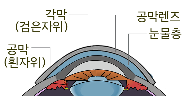 공막렌즈 착용단면