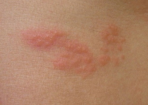 대상포진 초기증상