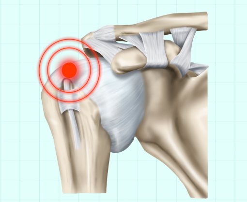 회전근개증후군의 원인