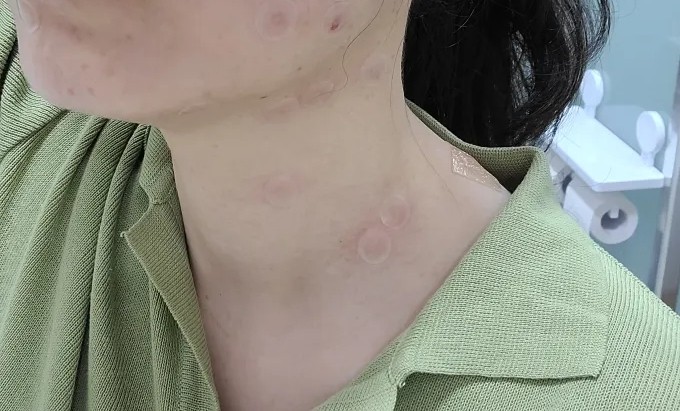 쥐젖 레이저 후