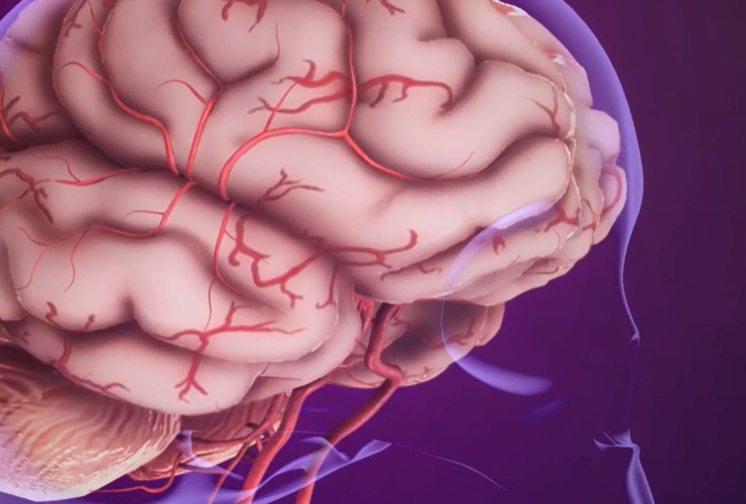 모야모야병 증상