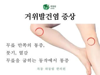 거위발 건염 원인과 증상 무릎 안쪽 통증 치료법 정리_5