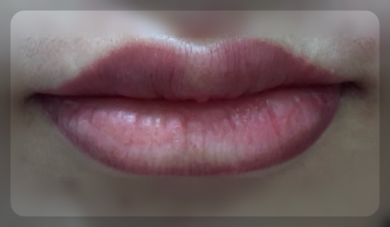 립타투 시술 직후 붓기와 붉어진 입술 상태