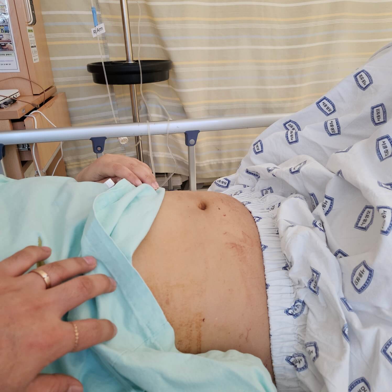 거대자궁근종수술후