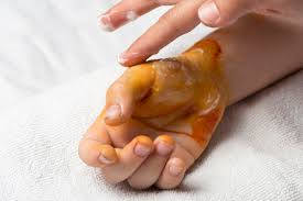 화상 물집 치료방법, 터뜨리지 말고 이렇게 치료하세요!