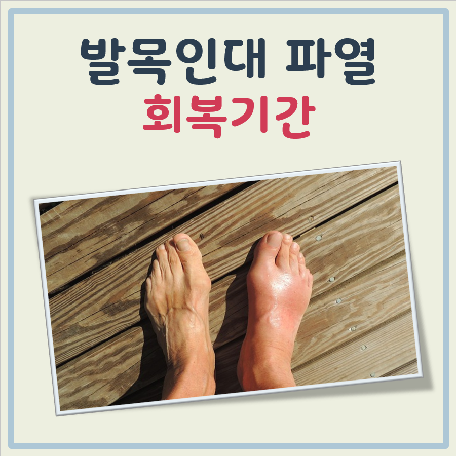 발목 인대 파열 회복기간 대표 이미지