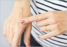 모공막힘&amp;#44; 여드름&amp;#44; 상처부위 등의 이미지