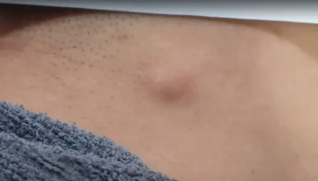 표피낭