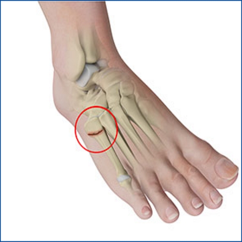 발등 피로골절