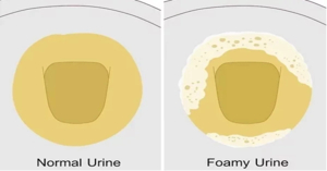 소변 거품(거품뇨)란