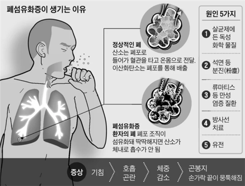 폐섬유증이 발생하는 원인