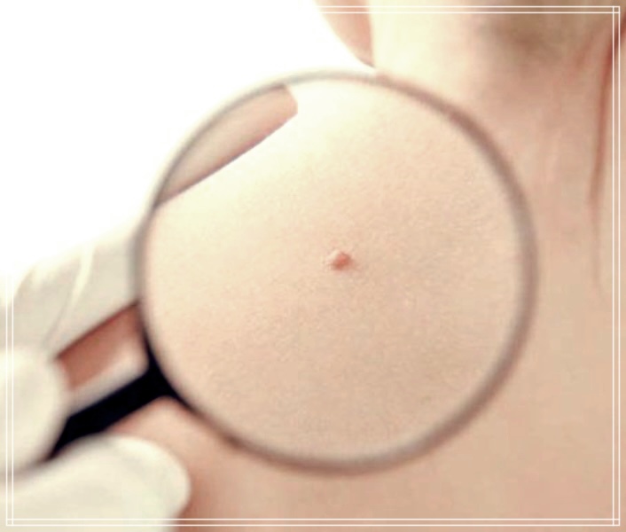 양성 종양과 악성 종양의 차이점