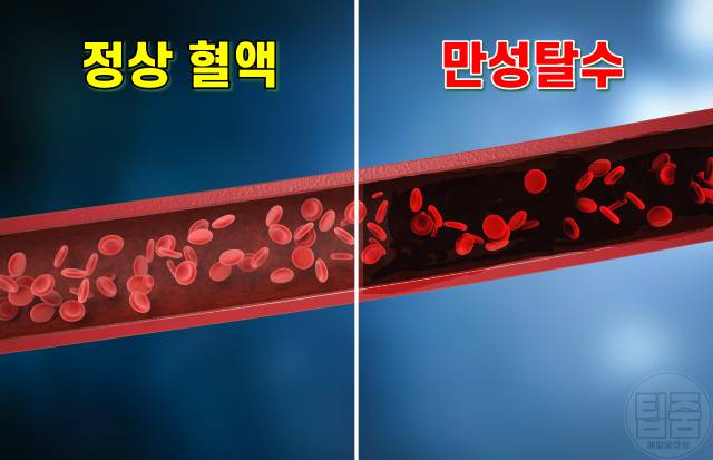 만성탈수 증상,만성탈수 질환,만성탈수 자가진단법,혈액순환,뇌졸중,팁줌