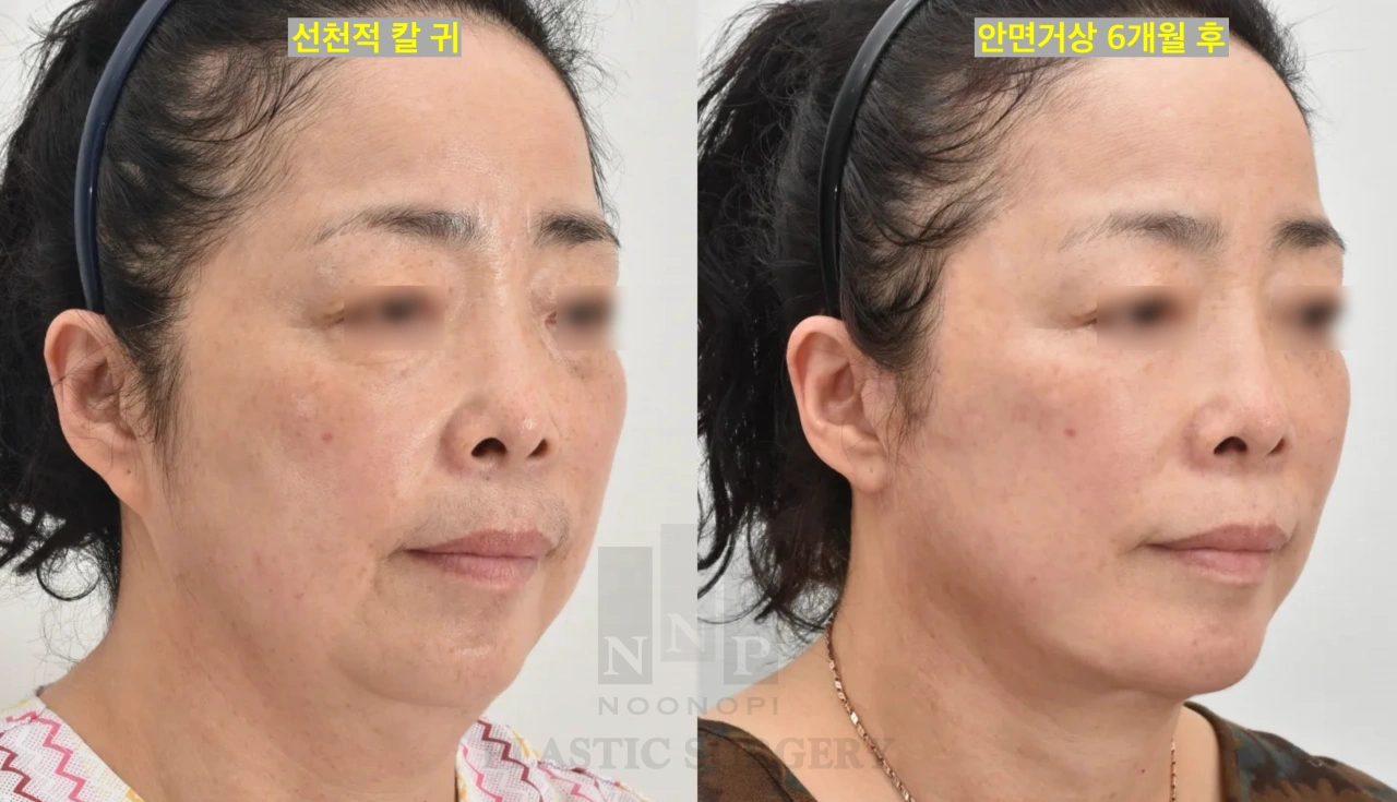 선천적 칼귀를 안면거상하면서 교정