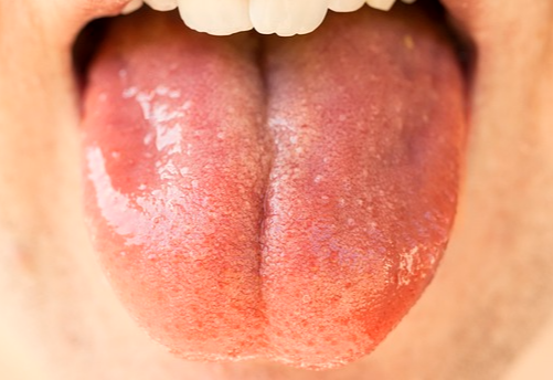 입냄새 심한 이유