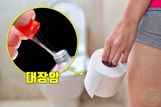 암 초기증상,대장암 증상