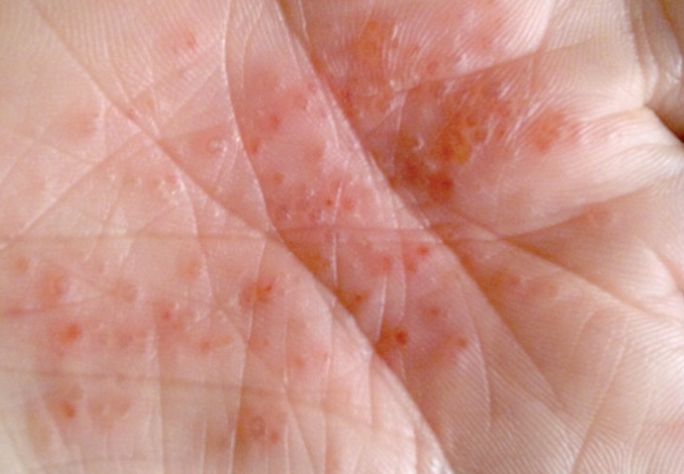 한포진(pompholyx)