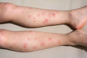 모기 물려 가려울 때 땀띠에 안티푸라민 연고 효능 부작용 사용후기_5