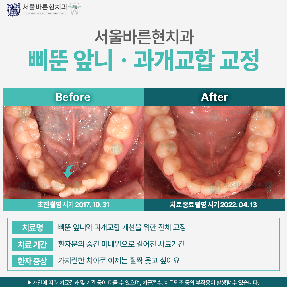 해운대 앞니교정