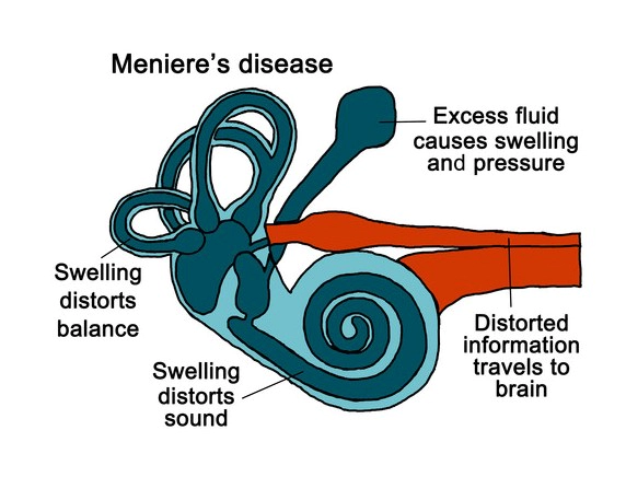 메니에르병 증상 4가지