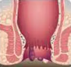 치질-증상-자가치료법-건강