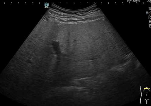 알코올성 간질환