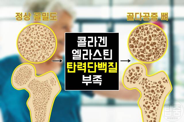 얼굴주름 골다공증 팔자주름 귓볼주름 심장마비