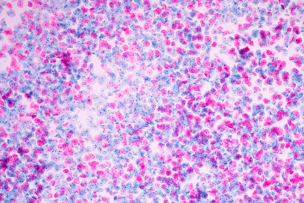 성기사마귀는-성병-중-하나로-인간-유두종-바이러스(HPV)에-의해-발생