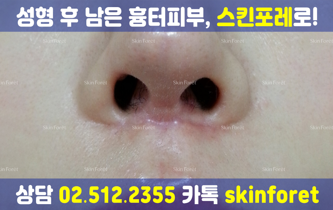 코 성형 전문 케어 전후, 코 흉살과 부작용 개선 모습