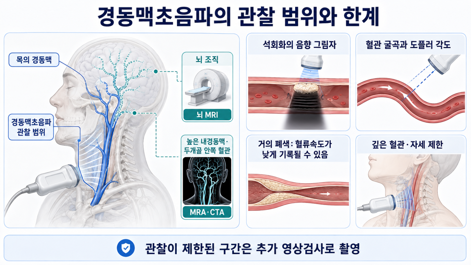 경동맥초음파 관찰 범위와 석회화 혈관 굴곡 거의 폐색 등 구조적 기술적 한계
