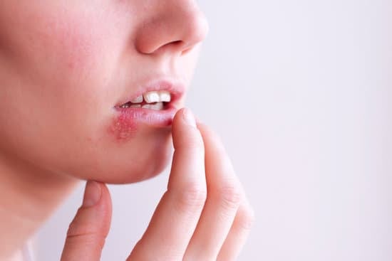 단순포진 (Herpes Simplex): 원인, 증상, 치료 및 예방법