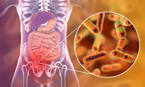 허혈성 대장염 증상과 원인, 치료방법, 예방법