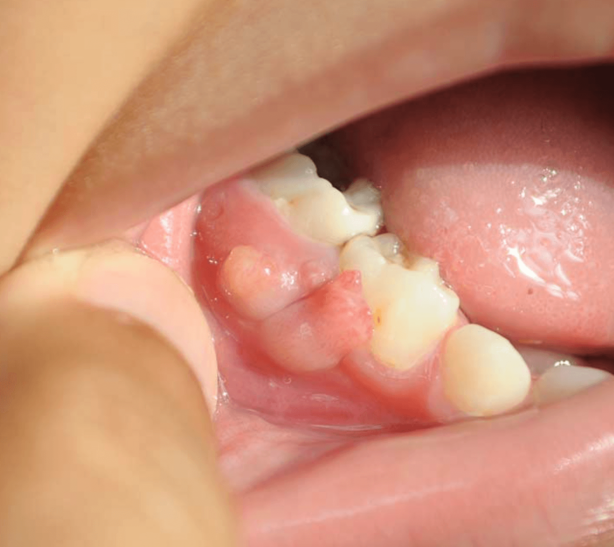 잇몸 염증 치료