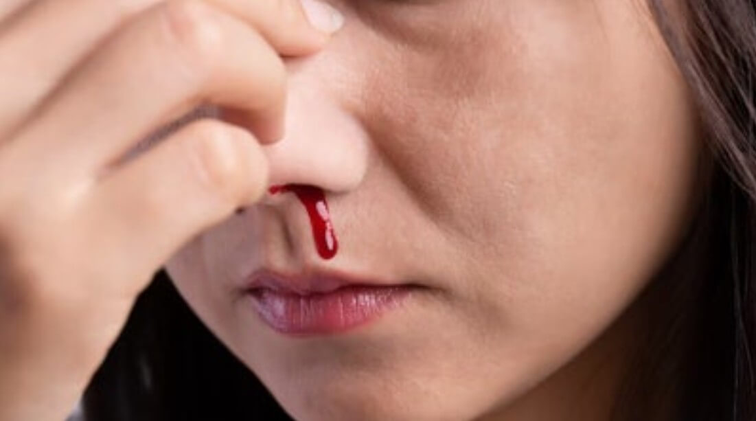 코피 흘리는 여성