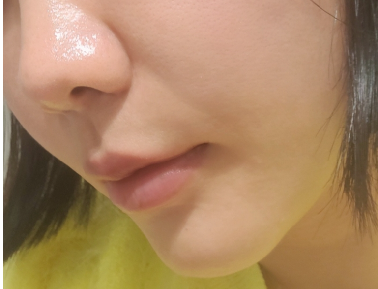 팔자 보톡스 후기