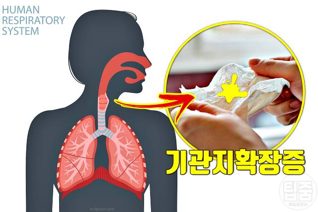 입냄새로 알아보는 건강 입냄새 썩은내 기관지확장증