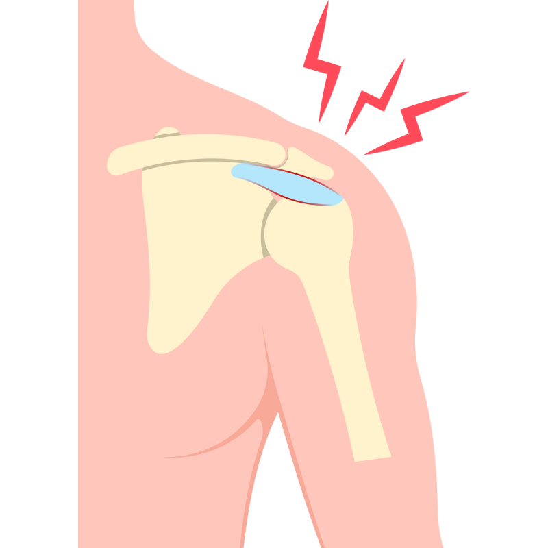 어깨 회전근개 파열 원인