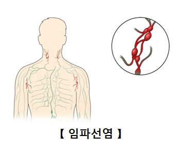 임파선 원인 증상 치료하기 면역력 기르기 알아봐요