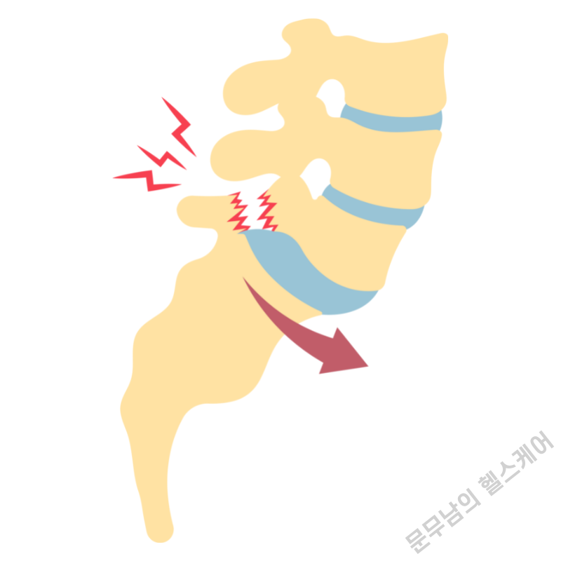 척추 분리증 증상과 치료법