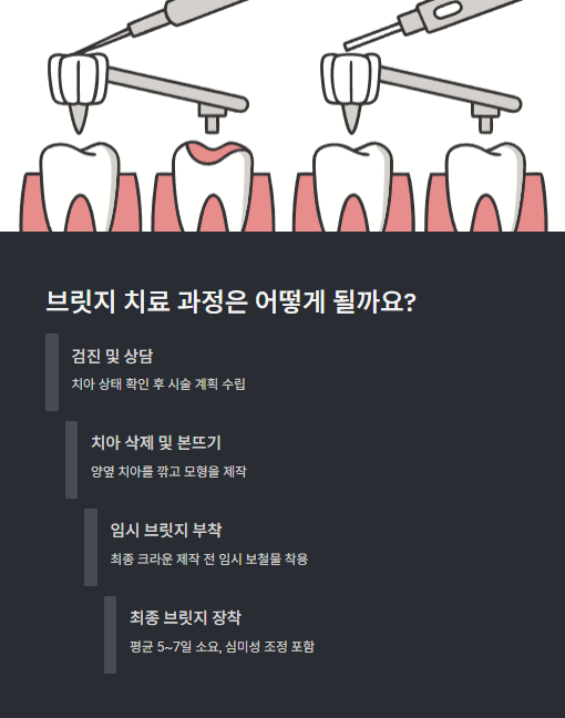 브릿지 치료 과정은 어떻게 될까요?