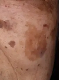 검버섯과 흑자