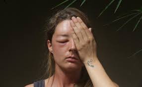 눈 붓기 빨리 빼는법