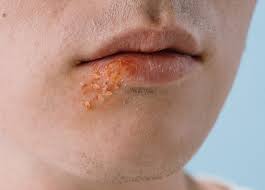 입술 포진 빨리 낫는법