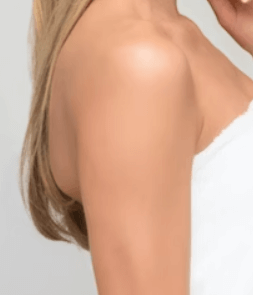 모공각화증 치료방법 - 레이저 치료