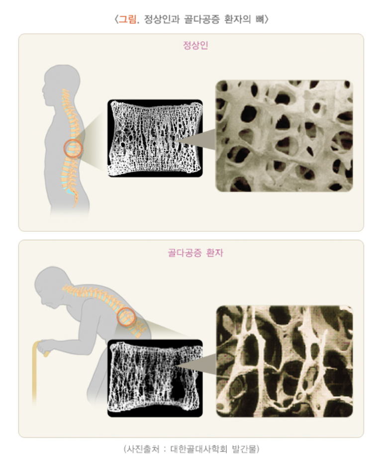 골다공증 환자의 뼈