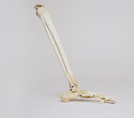 통풍 치료법 진단 기준 합병증