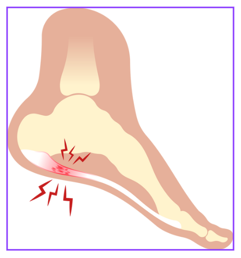 족저근막염 증상 자가 치료법 깔창 선택 방법